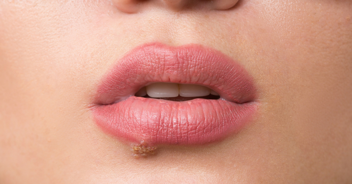 Cold Sore Versus Canker Sore